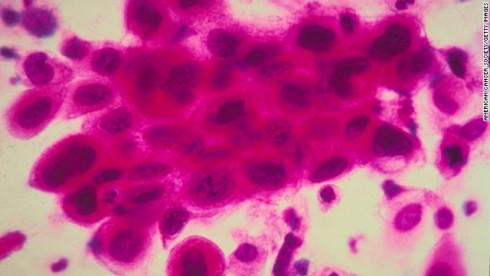 cervix-cancer-cells-story-top